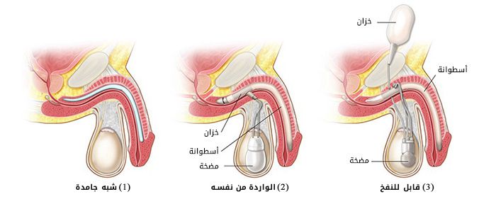 تركيب الدعامة الذكرية في الهند